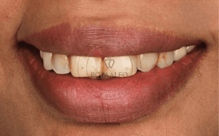 Smile Correction with Composite