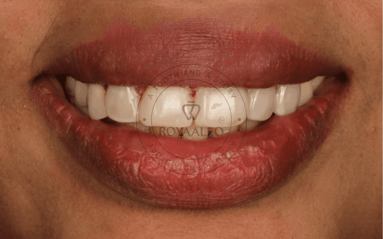 Smile Correction with Composite