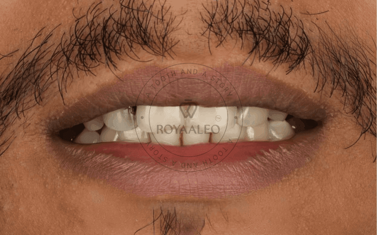 Smile Correction with Composite
