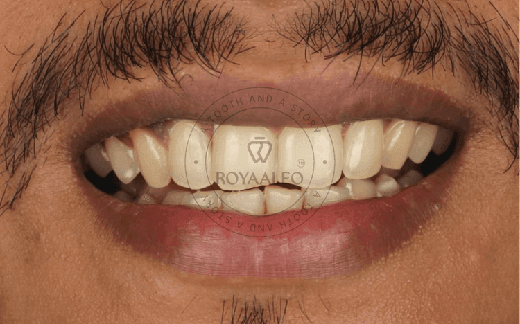 Smile Correction with Composite