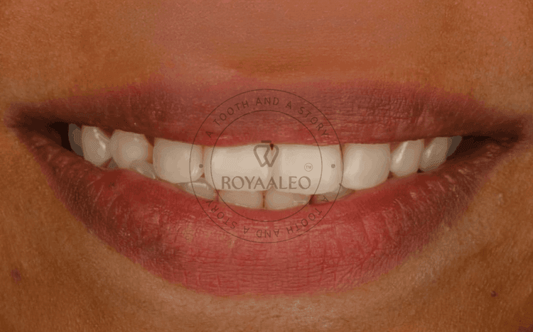 Smile Correction with 5 Composite Restorations