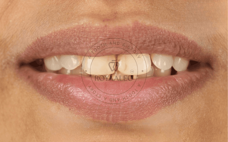 Composite Smile Correction – 10 Teeth