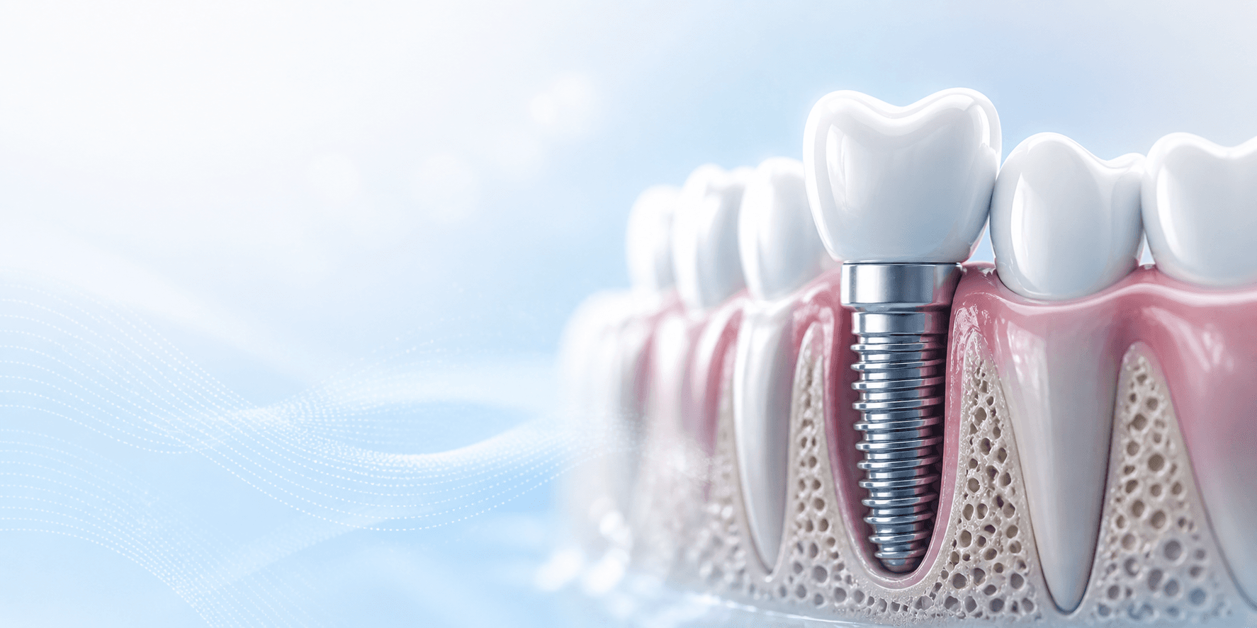 Implant