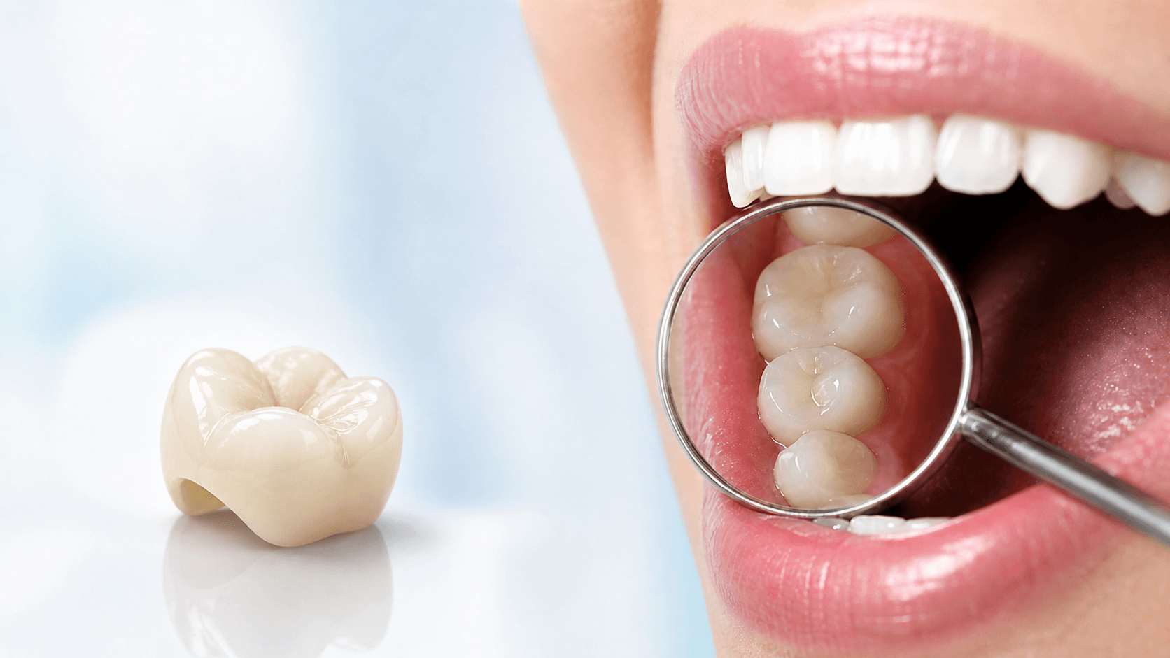 Dental Crown