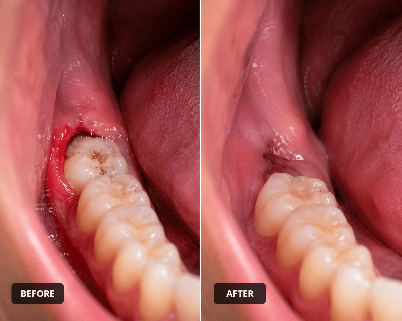 Wisdom Tooth