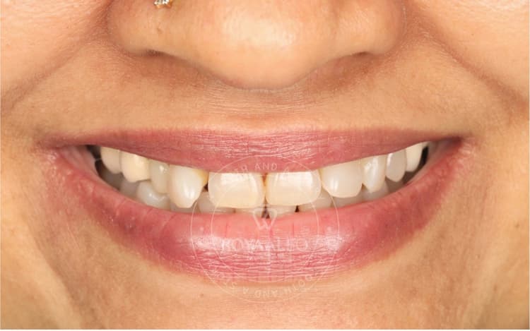 before-image