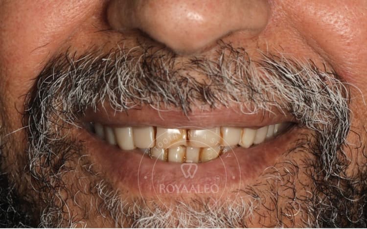before-image