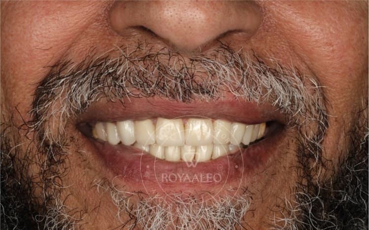 after-image