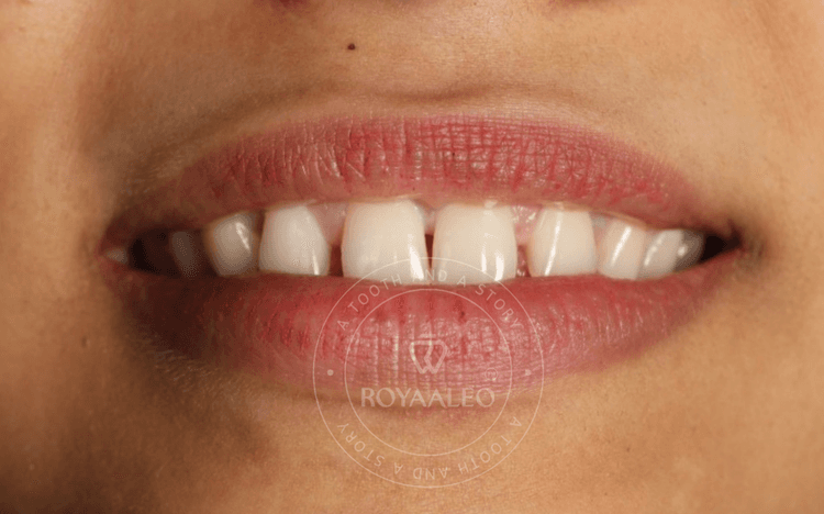 before-image