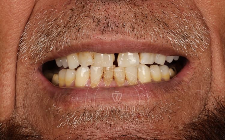 before-image