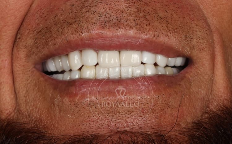 after-image